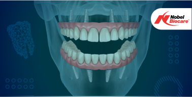 "All on Four" System by Nobel (w/fixed hybrid denture)